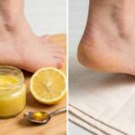 Quick Healing Method for Dry Cracked Heels Using Simple Kitchen Ingredients